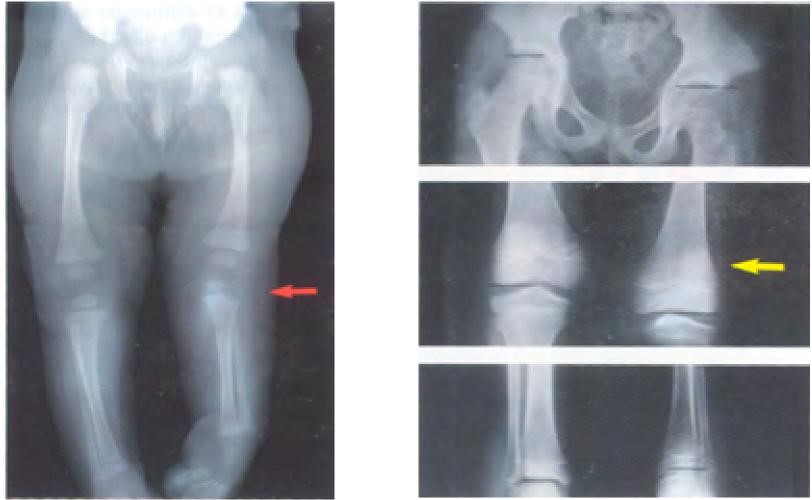 Management Of Pediatric Lower Limb Length Inequality | Dayton Children's